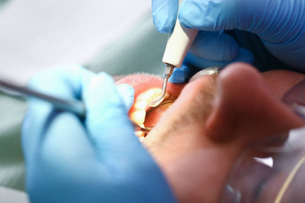 Emergency Dental Filling Replacement in MA